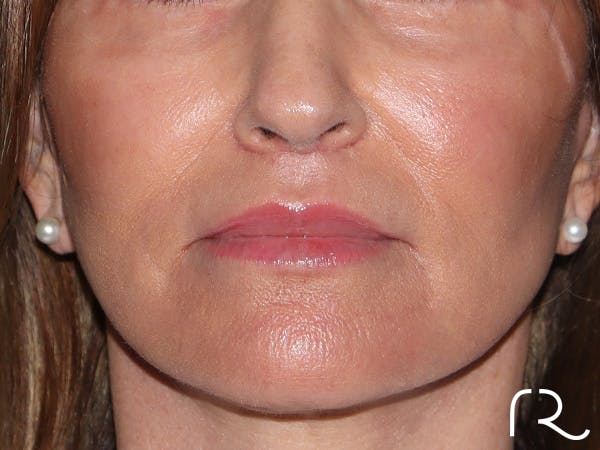 Lip Lift Before & After Gallery - Patient 422442 - Image 2