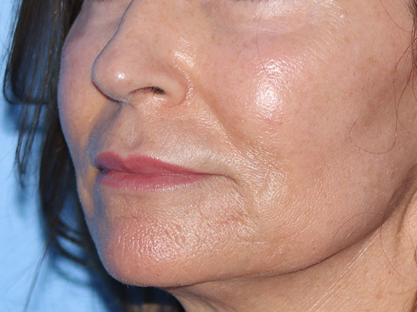 Lip Lift Before & After Gallery - Patient 422442 - Image 3