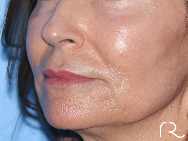 Lip Lift Before & After Gallery - Patient 422442 - Image 3