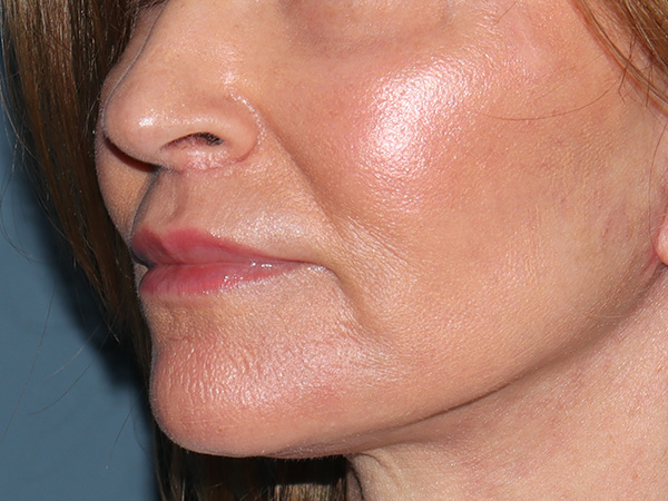 Lip Lift Before & After Gallery - Patient 422442 - Image 4