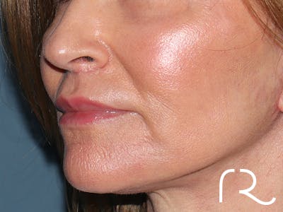 Lip Lift Before & After Gallery - Patient 422442 - Image 4