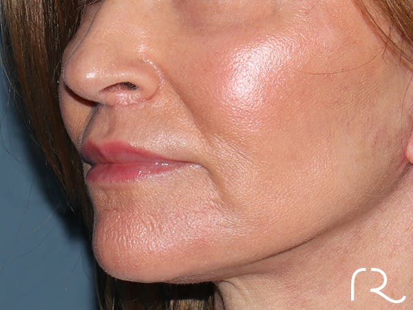 Lip Lift Before & After Gallery - Patient 422442 - Image 4