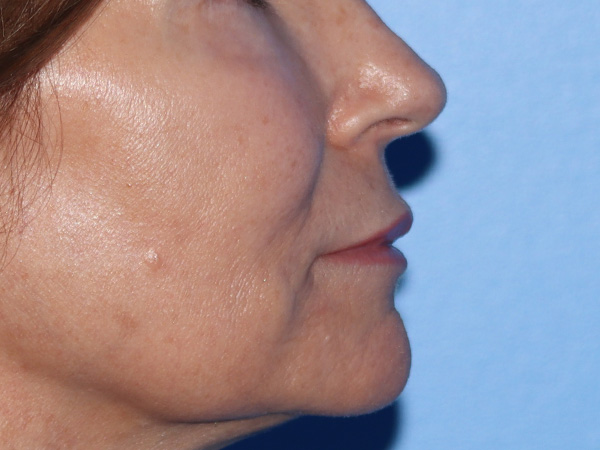 Lip Lift Before & After Gallery - Patient 422442 - Image 5