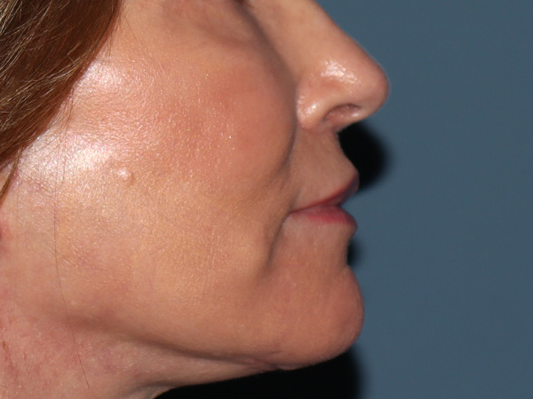Lip Lift Before & After Gallery - Patient 422442 - Image 6