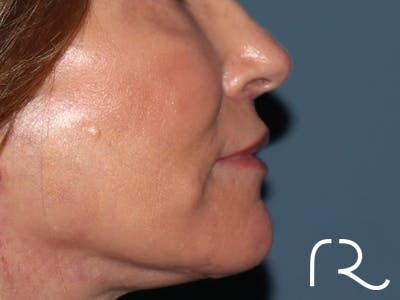 Lip Lift Before & After Gallery - Patient 422442 - Image 6