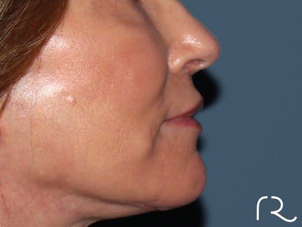 Lip Lift Before & After Gallery - Patient 422442 - Image 6