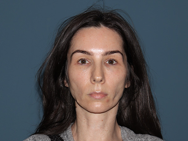 Fractional CO2 Laser Resurfacing Before & After Gallery - Patient 513110 - Image 1