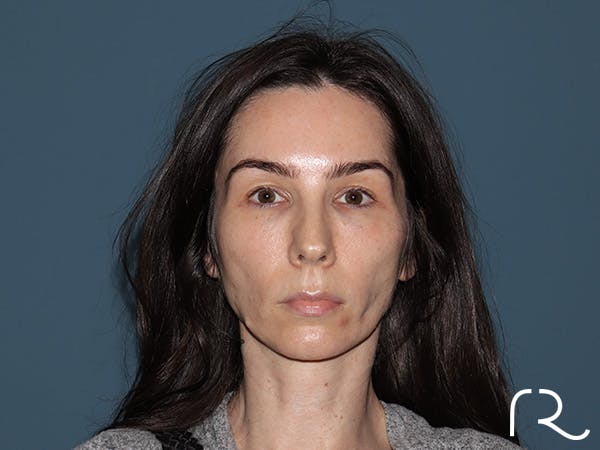 Facelift Before & After Gallery - Patient 148605 - Image 3