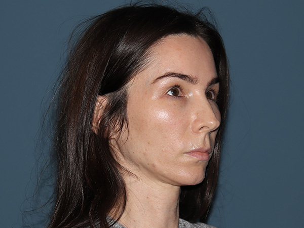 Neck Lift Before & After Gallery - Patient 153043 - Image 1