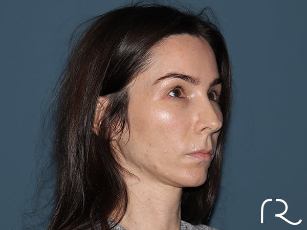 Facelift Before & After Gallery - Patient 148605 - Image 1