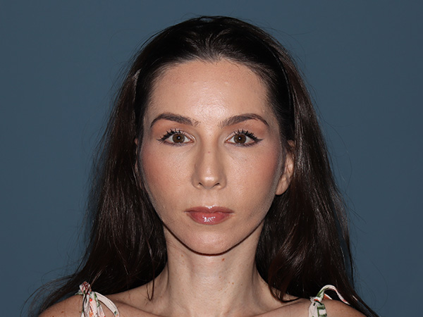 Facelift Before & After Gallery - Patient 148605 - Image 4