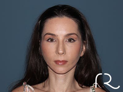 Facelift Before & After Gallery - Patient 148605 - Image 4