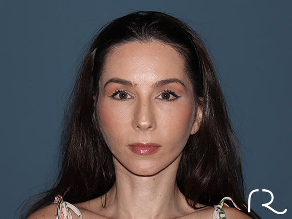 Facelift Before & After Gallery - Patient 148605 - Image 4