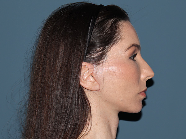 Facelift Before & After Gallery - Patient 148605 - Image 6