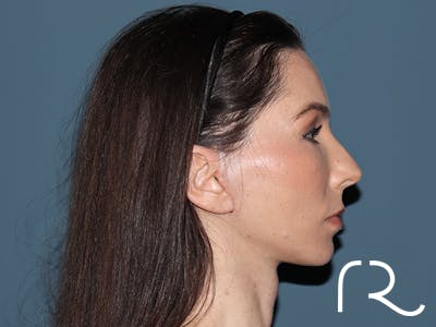 Facelift Before & After Gallery - Patient 148605 - Image 6
