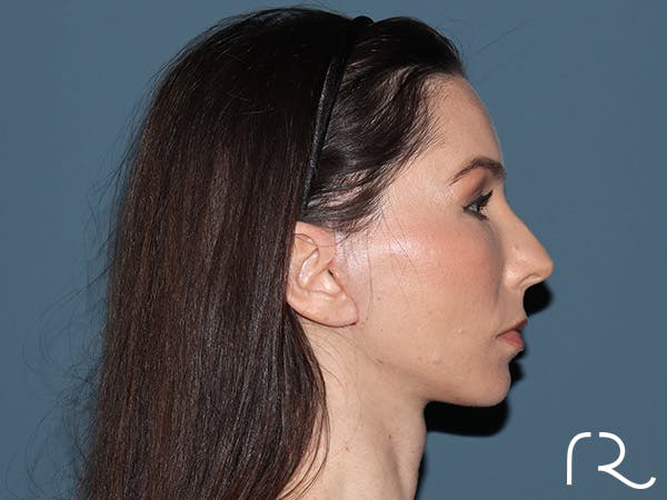 Facelift Before & After Gallery - Patient 148605 - Image 6