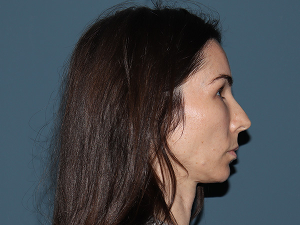 Facelift Before & After Gallery - Patient 148605 - Image 5