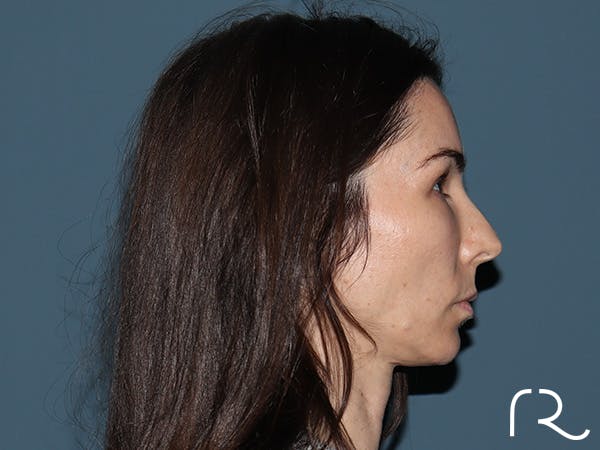Facelift Before & After Gallery - Patient 148605 - Image 5