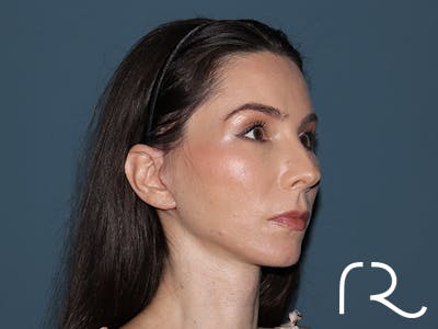 Facelift Before & After Gallery - Patient 148605 - Image 2