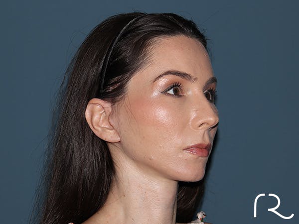 Facelift Before & After Gallery - Patient 148605 - Image 2