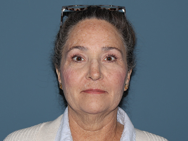 Fractional CO2 Laser Resurfacing Before & After Gallery - Patient 399519 - Image 1