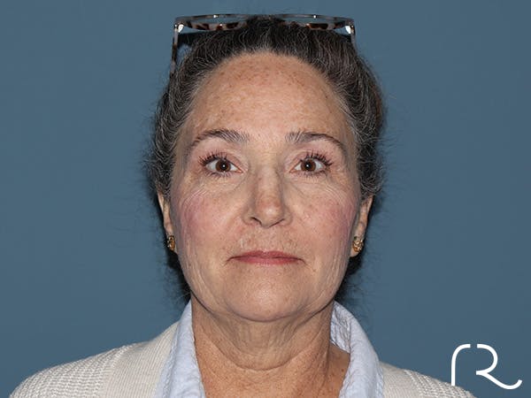 Brow Lift Before & After Gallery - Patient 397754 - Image 1