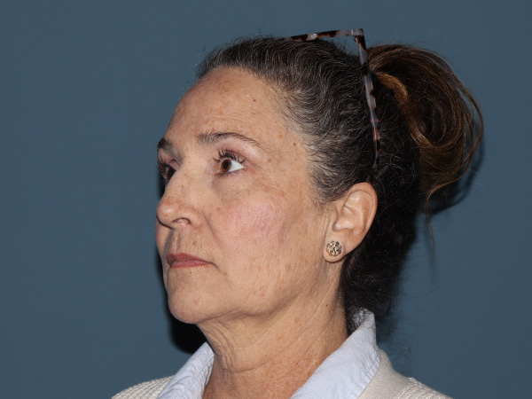 Facelift Before & After Gallery - Patient 154308 - Image 1