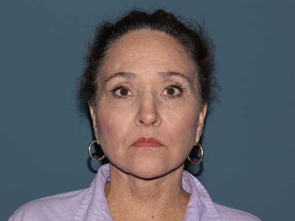 Fractional CO2 Laser Resurfacing Before & After Gallery - Patient 399519 - Image 2