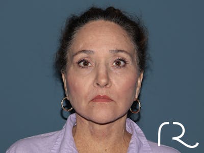 Brow Lift Before & After Gallery - Patient 397754 - Image 2