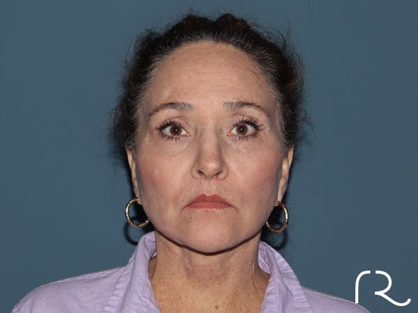 Brow Lift Before & After Gallery - Patient 397754 - Image 2