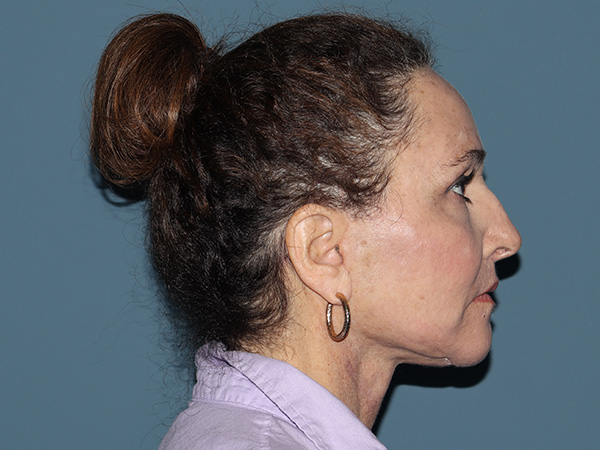 Fractional CO2 Laser Resurfacing Before & After Gallery - Patient 399519 - Image 6