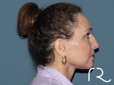 Brow Lift Before & After Gallery - Patient 397754 - Image 6