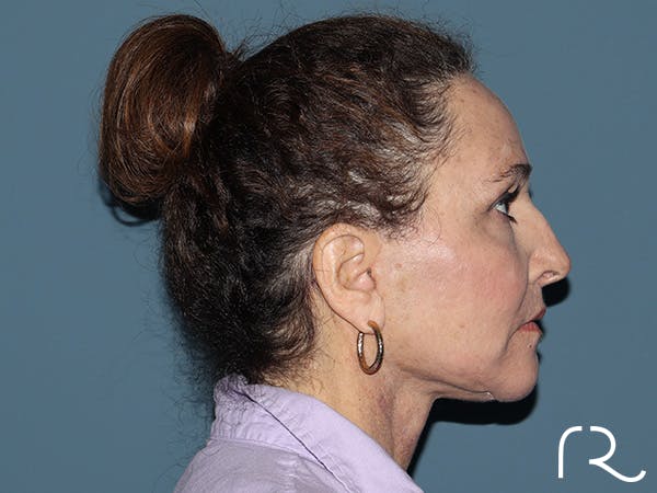 Brow Lift Before & After Gallery - Patient 397754 - Image 6