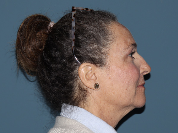 R2 Extended Deep Neck Lift Before & After Gallery - Patient 243157 - Image 1