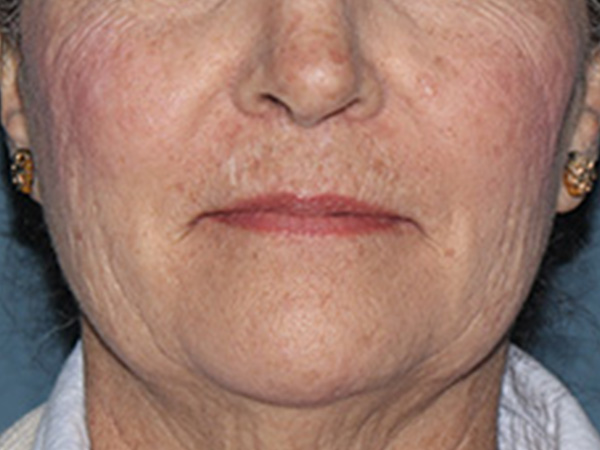 Lip Lift Before & After Gallery - Patient 110145 - Image 1