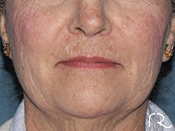 Lip Lift Before & After Gallery - Patient 110145 - Image 1