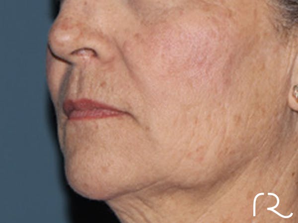 Lip Lift Before & After Gallery - Patient 110145 - Image 3