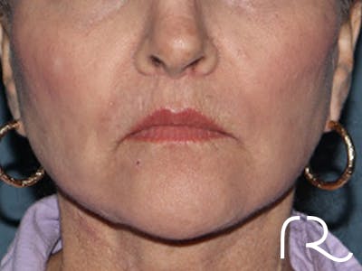 Lip Lift Before & After Gallery - Patient 110145 - Image 2