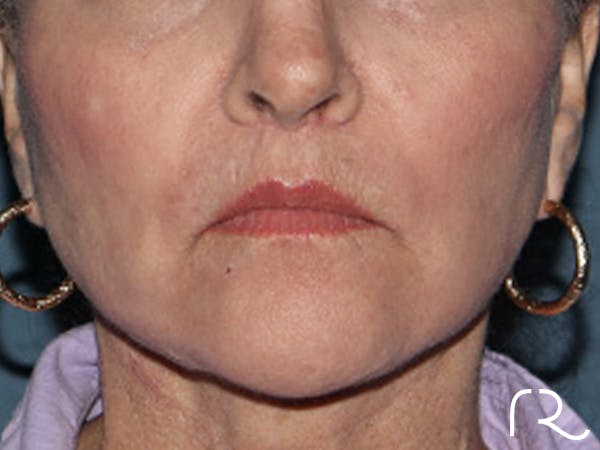 Lip Lift Before & After Gallery - Patient 110145 - Image 2