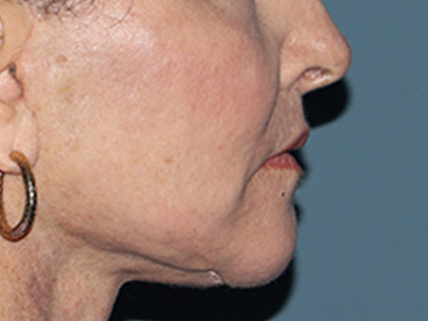 Lip Lift Before & After Gallery - Patient 110145 - Image 6