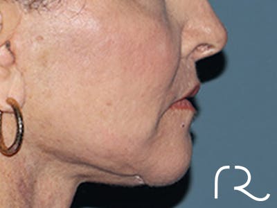 Lip Lift Before & After Gallery - Patient 110145 - Image 6