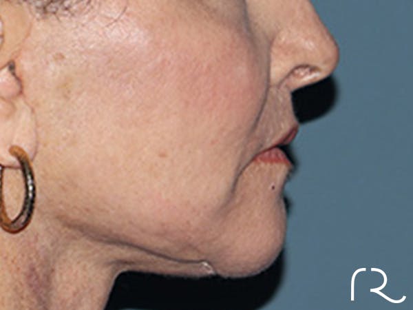 Lip Lift Before & After Gallery - Patient 110145 - Image 6