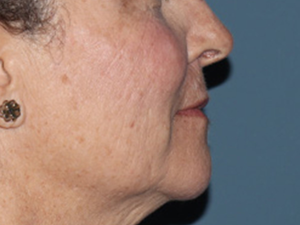 Lip Lift Before & After Gallery - Patient 110145 - Image 5