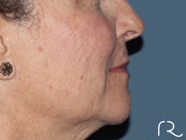 Lip Lift Before & After Gallery - Patient 110145 - Image 5