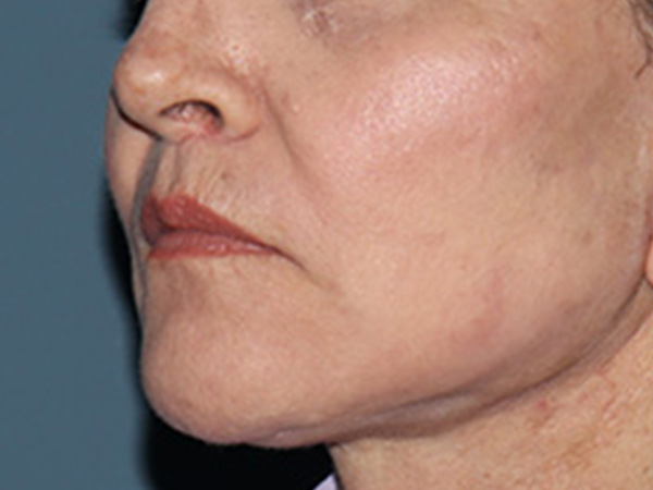 Lip Lift Before & After Gallery - Patient 110145 - Image 4