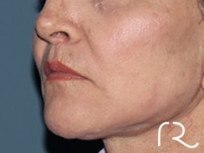 Lip Lift Before & After Gallery - Patient 110145 - Image 4