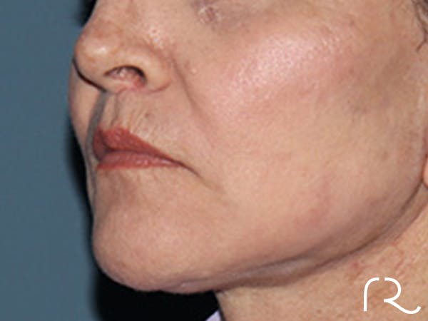 Lip Lift Before & After Gallery - Patient 110145 - Image 4