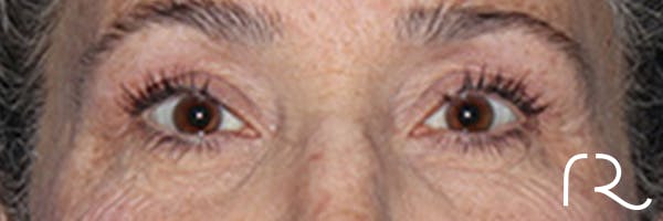 Eyelid Surgery Before & After Gallery - Patient 248201 - Image 1