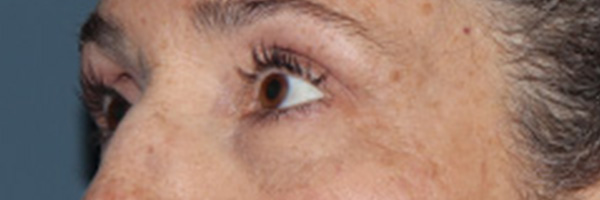 Eyelid Surgery Before & After Gallery - Patient 248201 - Image 3