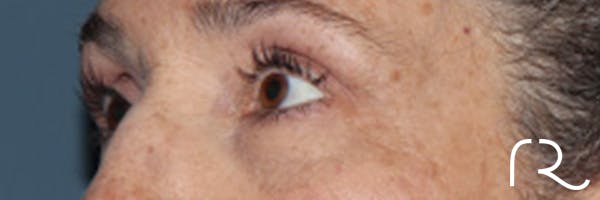 Eyelid Surgery Before & After Gallery - Patient 248201 - Image 3